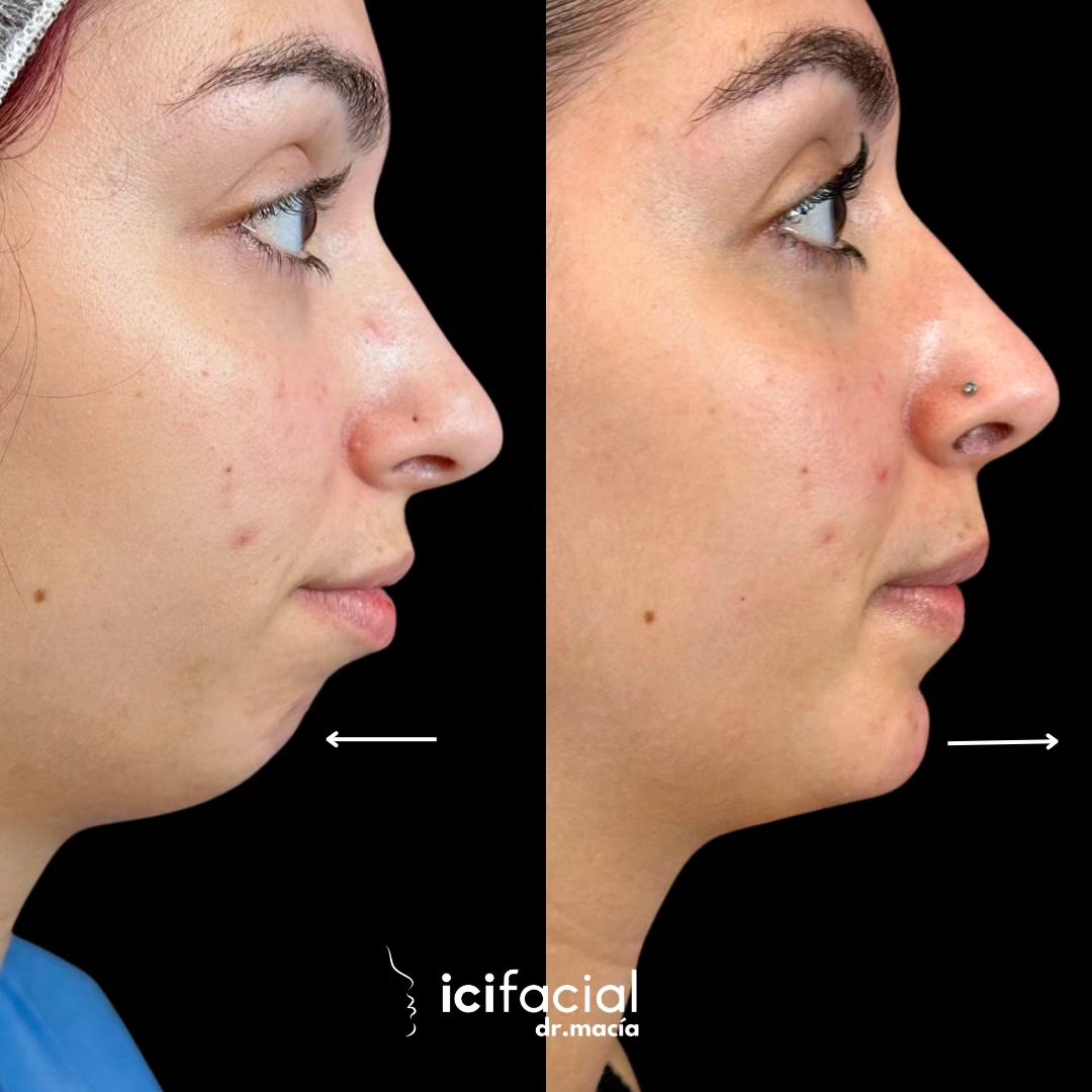 Mentoplastia